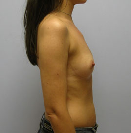 Breast Augmentation Before & After Image