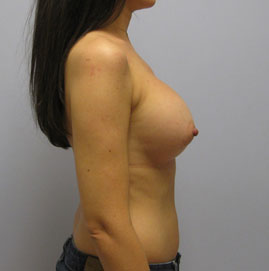 Breast Augmentation Before & After Image