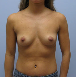 Breast Augmentation Before & After Image