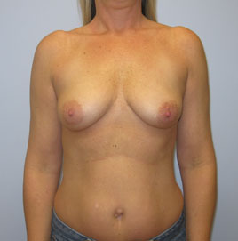 Breast Augmentation Before & After Image