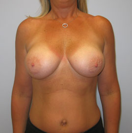 Breast Augmentation Before & After Image