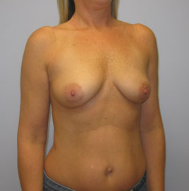 Breast Augmentation Before & After Image