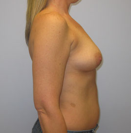 Breast Augmentation Before & After Image