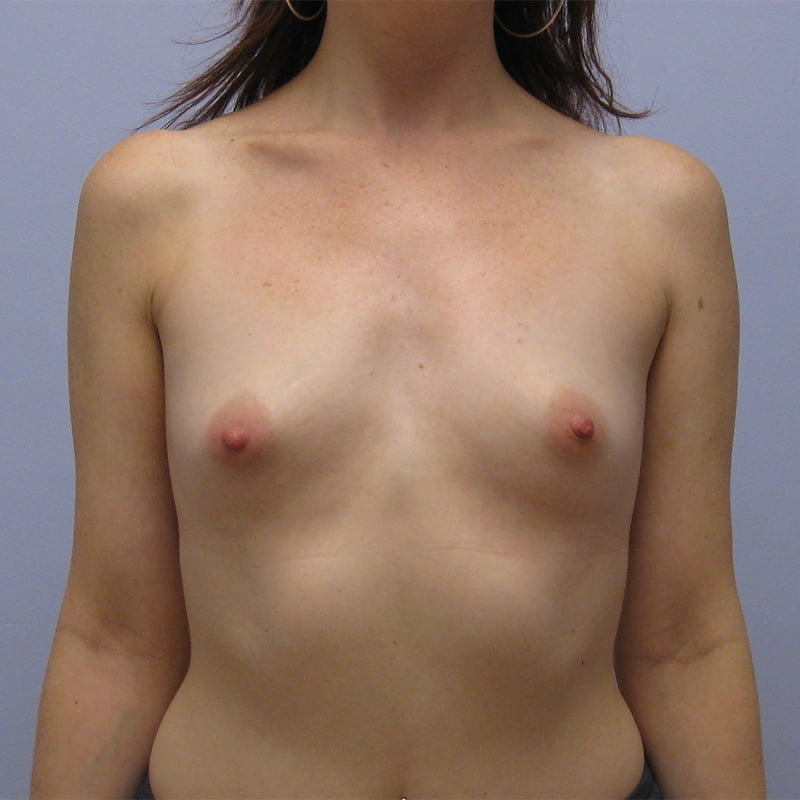 Breast Augmentation Before & After Image