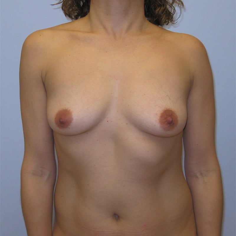 Breast Augmentation Before & After Image