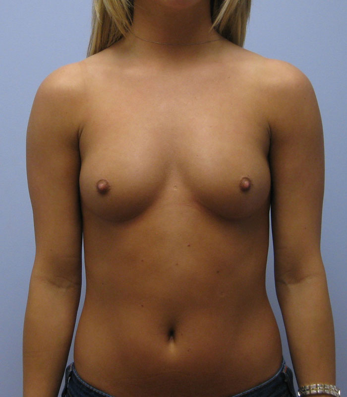 Breast Augmentation Before & After Image