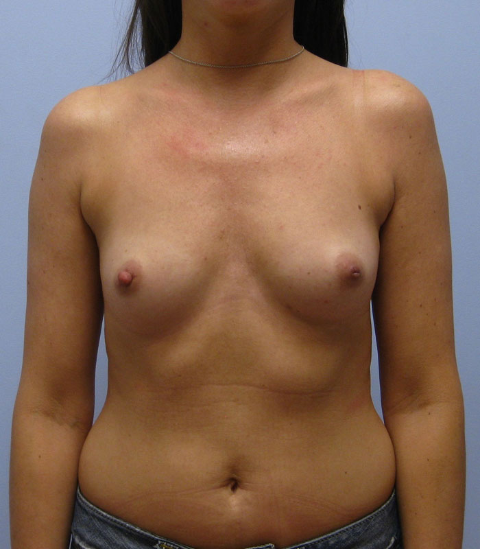 Breast Augmentation Before & After Image