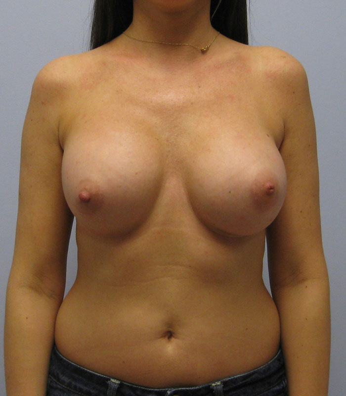 Breast Augmentation Before & After Image