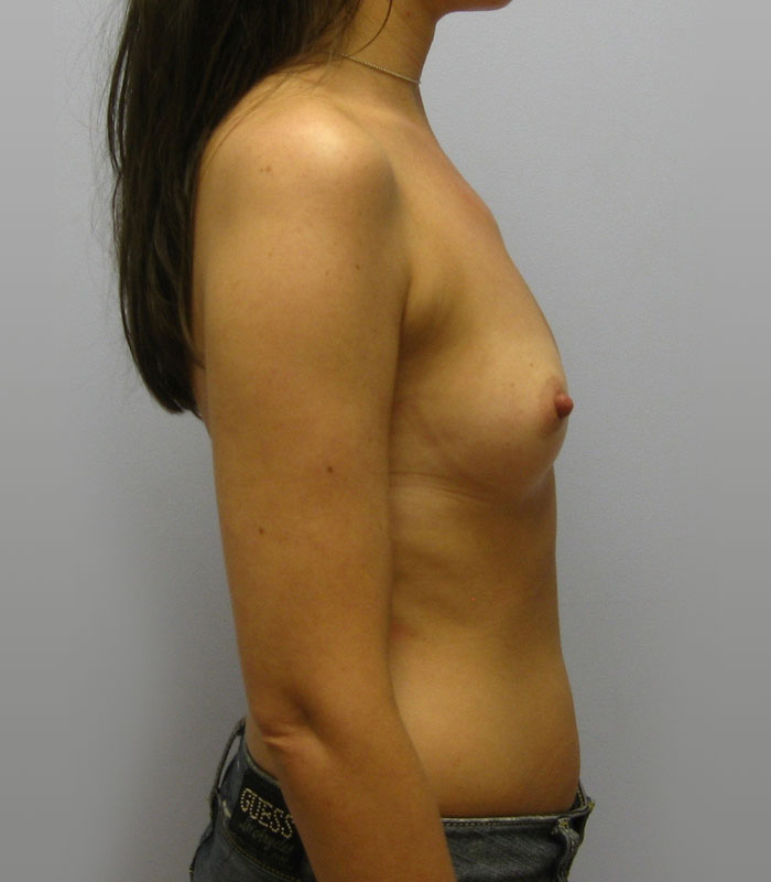 Breast Augmentation Before & After Image