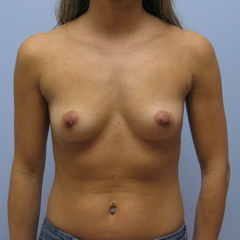 Breast Augmentation Before & After Image