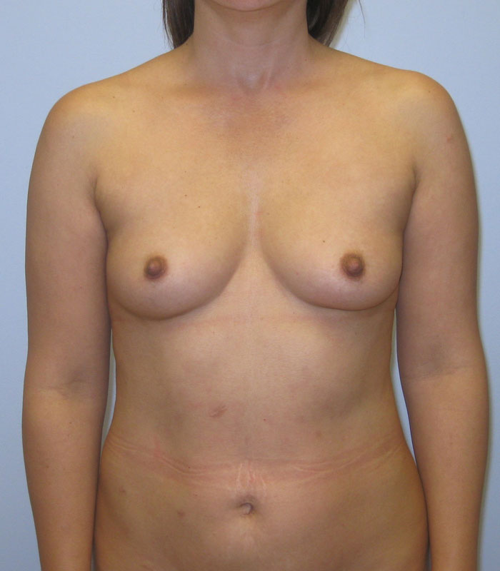 Breast Augmentation Before & After Image