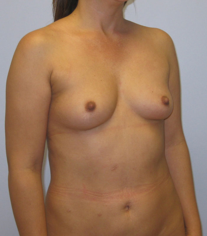 Breast Augmentation Before & After Image