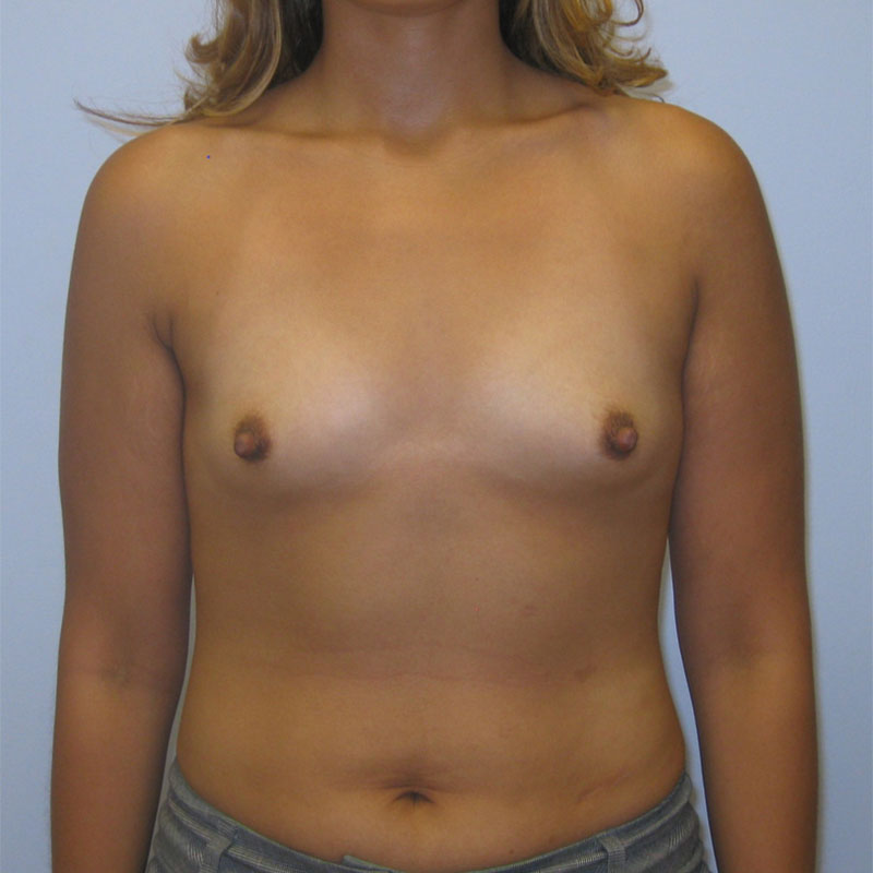 Breast Augmentation Before & After Image