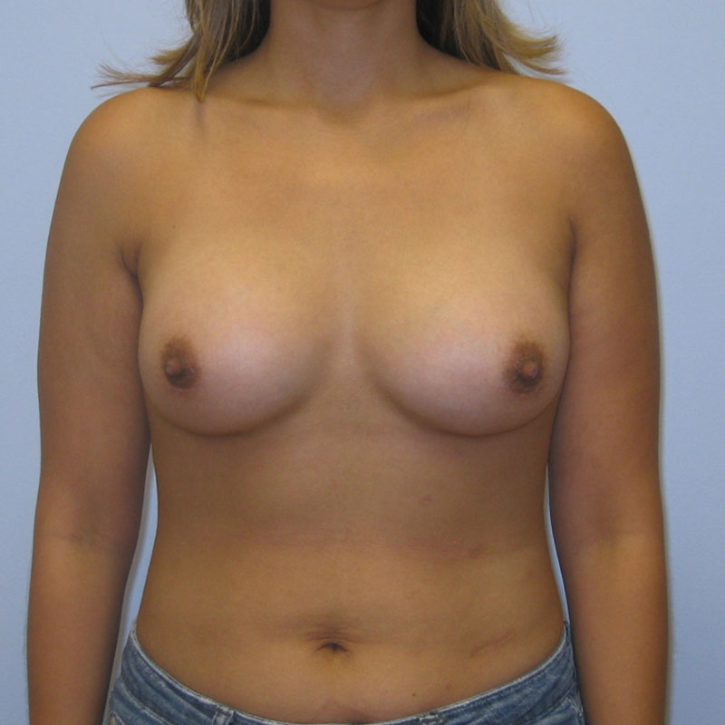 Breast Augmentation Before & After Image