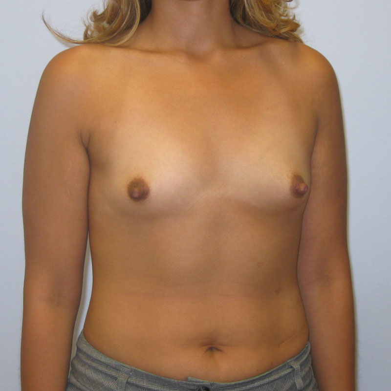 Breast Augmentation Before & After Image