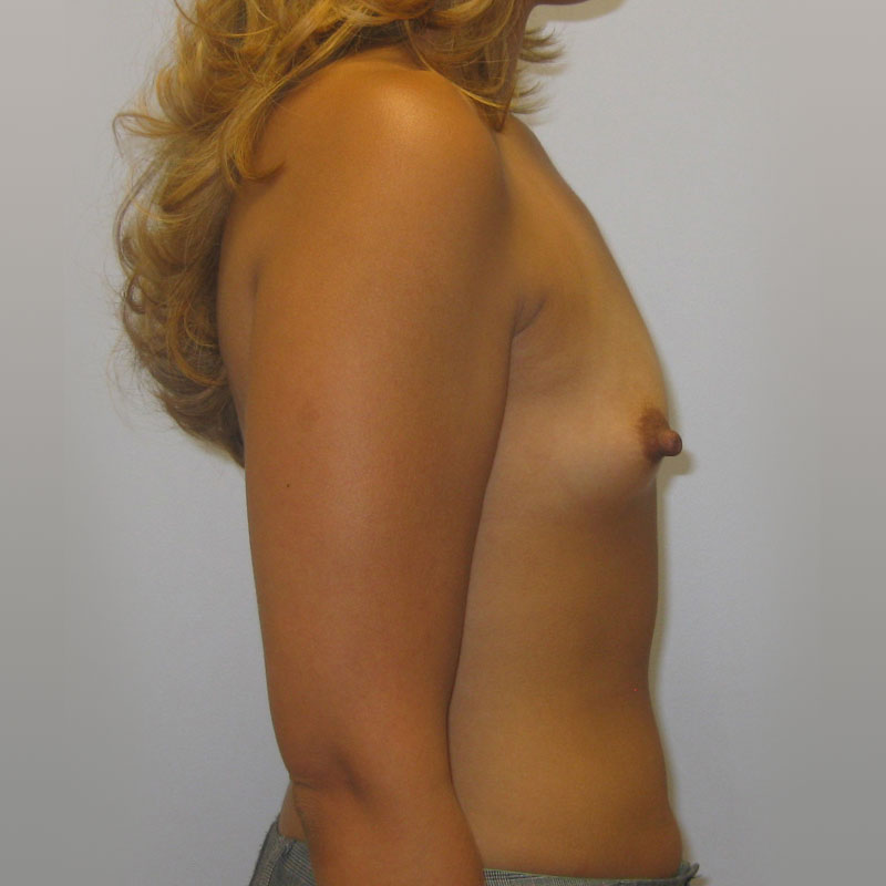 Breast Augmentation Before & After Image