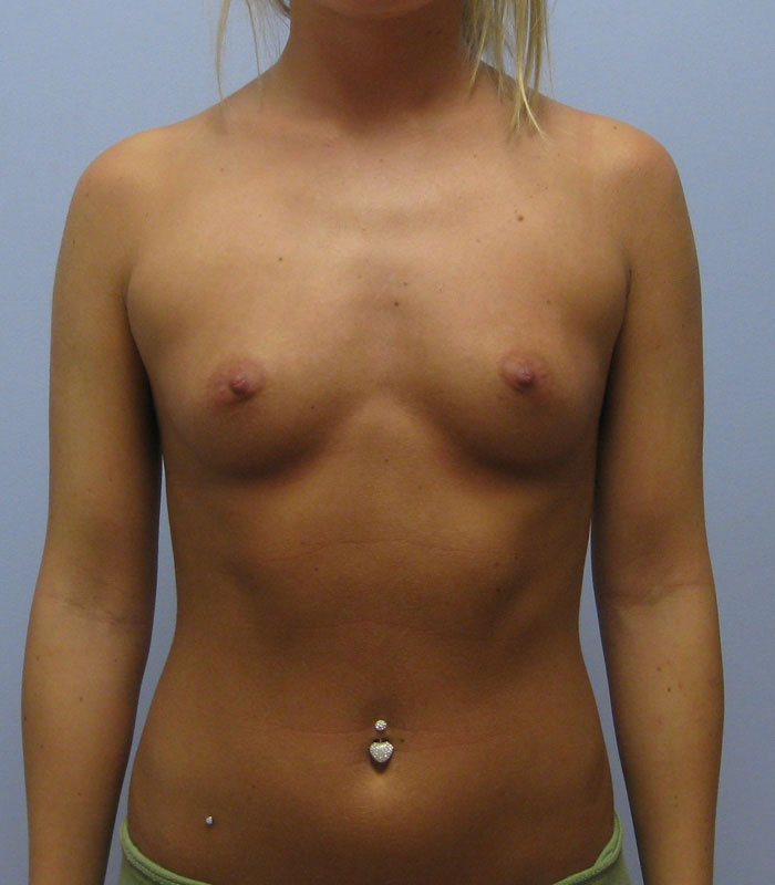 Breast Augmentation Before & After Image