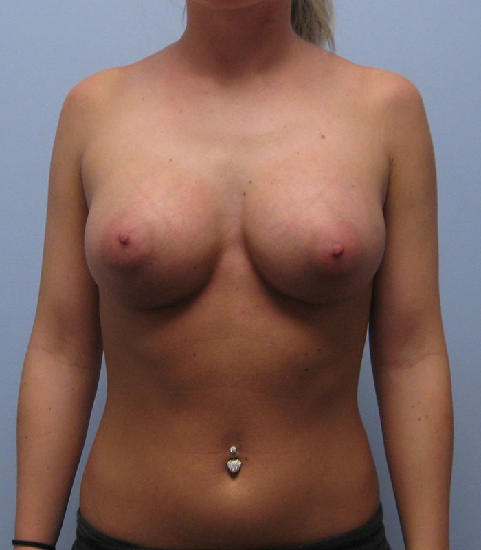 Breast Augmentation Before & After Image