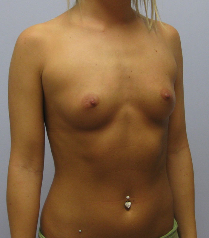 Breast Augmentation Before & After Image