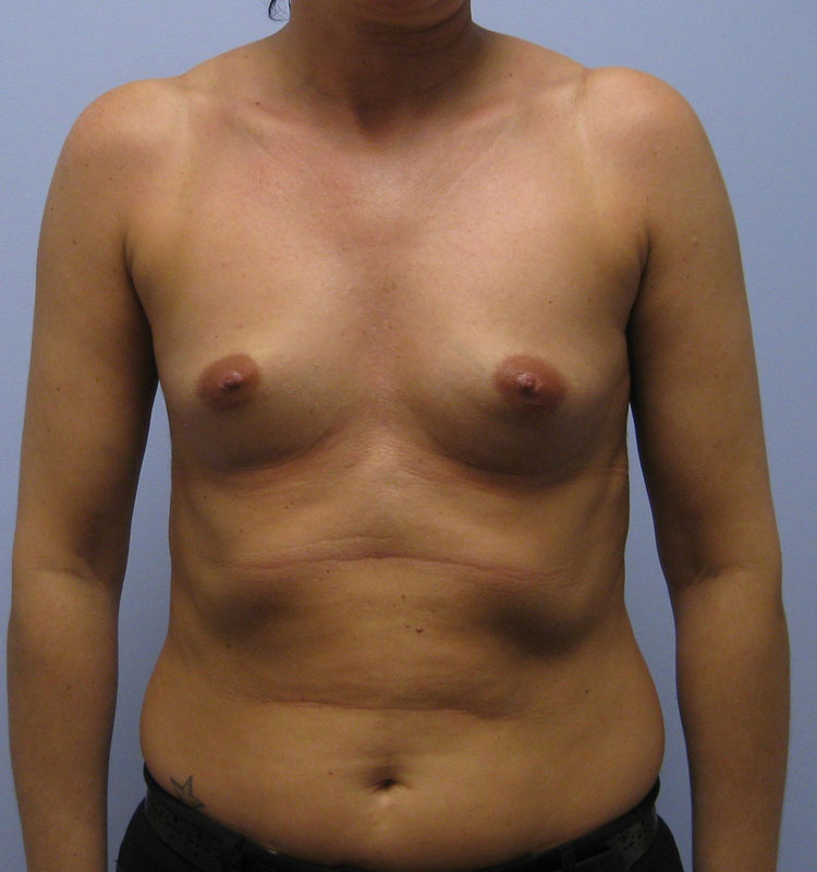 Breast Augmentation Before & After Image