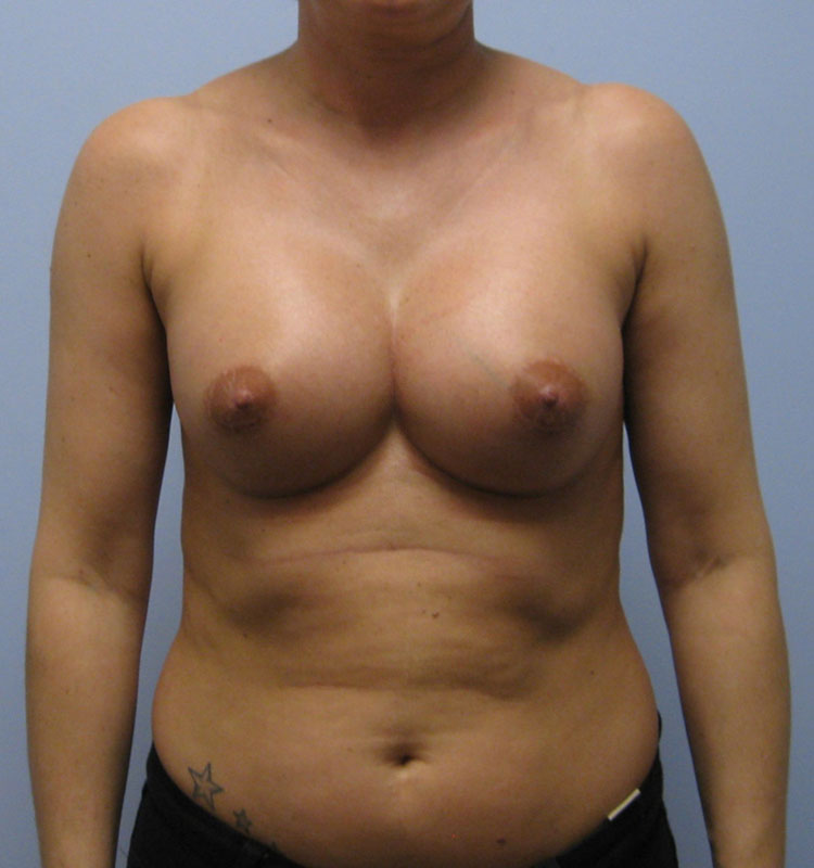 Breast Augmentation Before & After Image