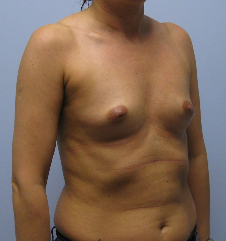 Breast Augmentation Before & After Image