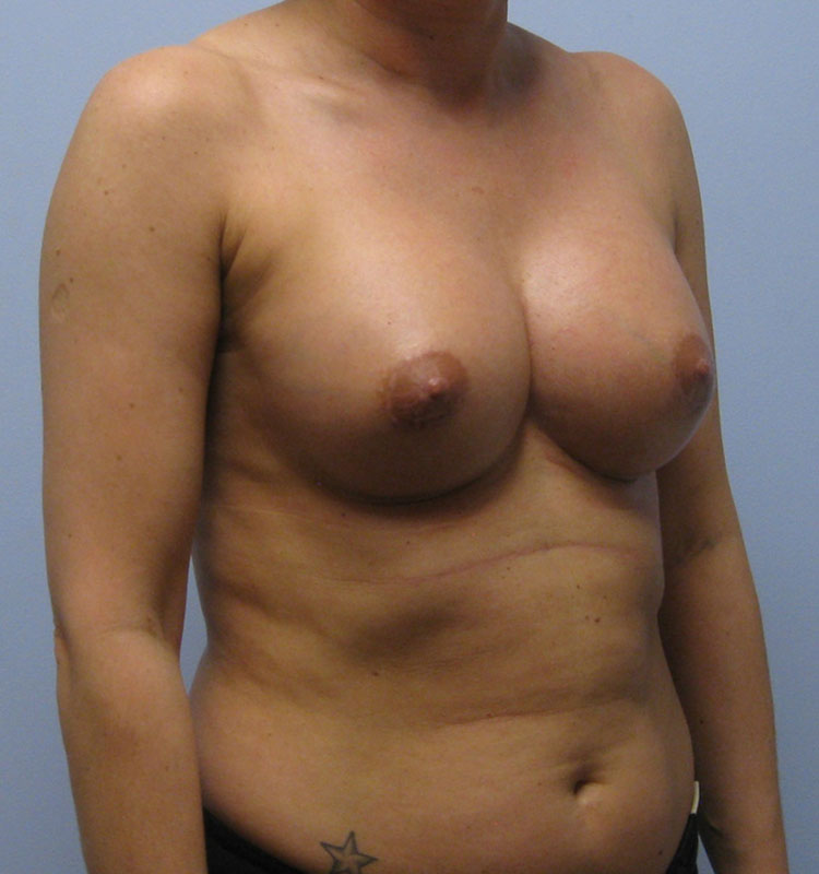 Breast Augmentation Before & After Image