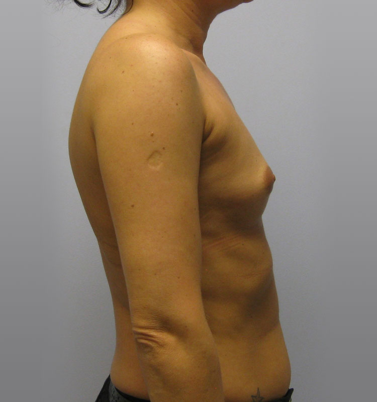 Breast Augmentation Before & After Image