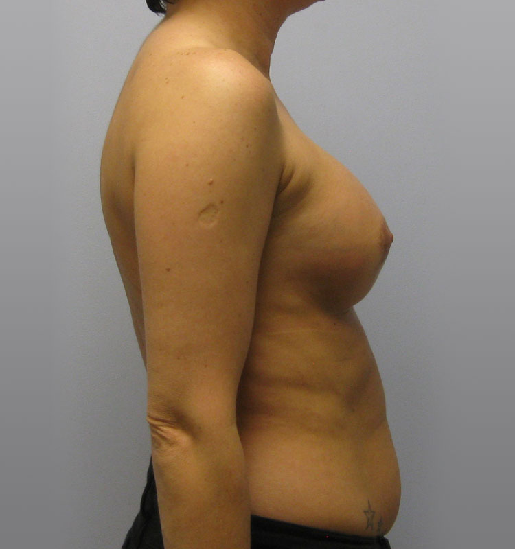 Breast Augmentation Before & After Image