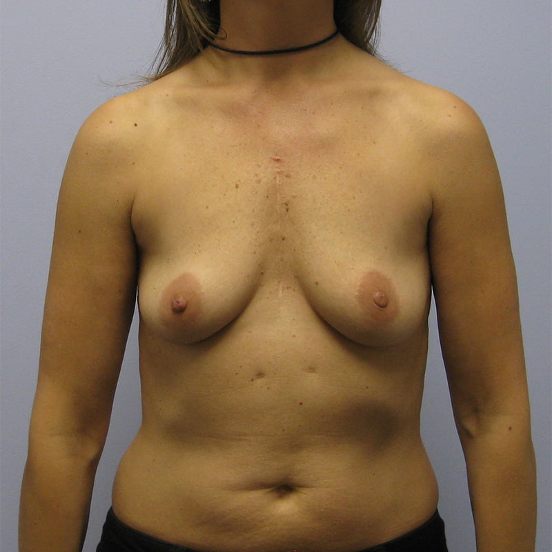 Breast Augmentation Before & After Image