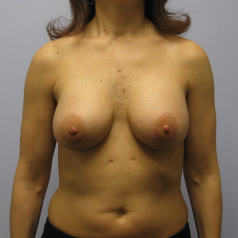 Breast Augmentation Before & After Image