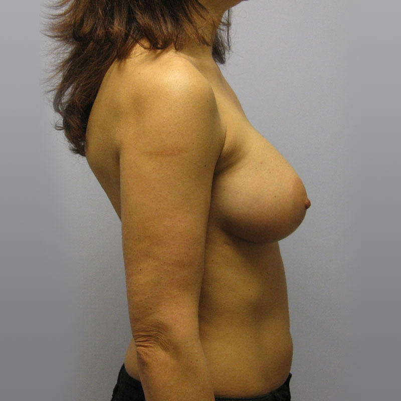 Breast Augmentation Before & After Image