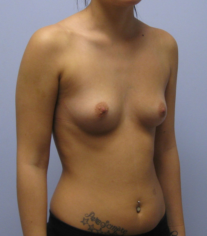 Breast Augmentation Before & After Image