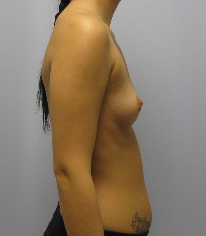 Breast Augmentation Before & After Image