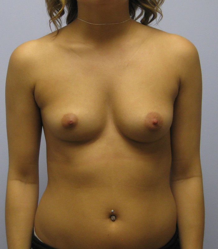 Breast Augmentation Before & After Image