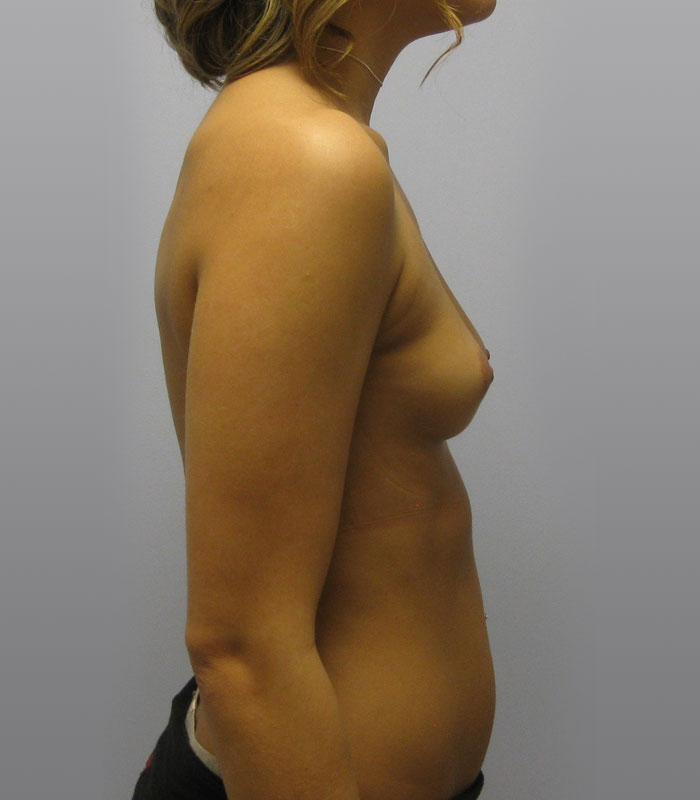 Breast Augmentation Before & After Image