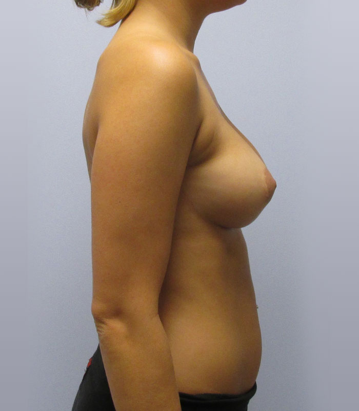 Breast Augmentation Before & After Image