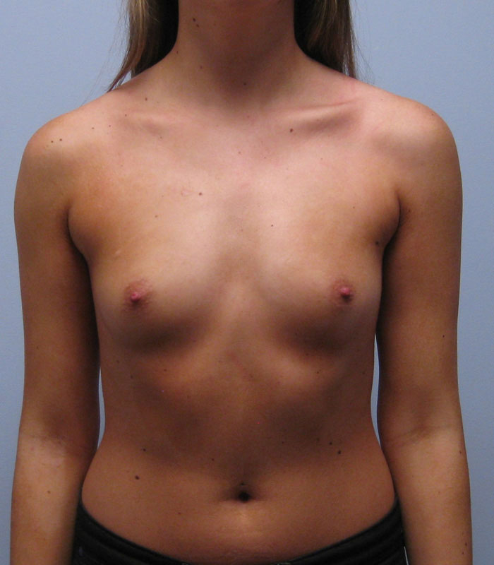 Breast Augmentation Before & After Image