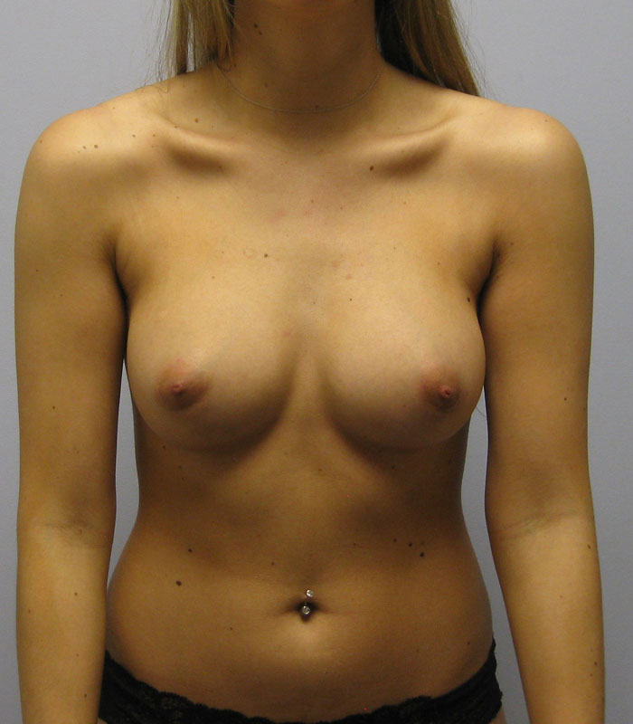 Breast Augmentation Before & After Image