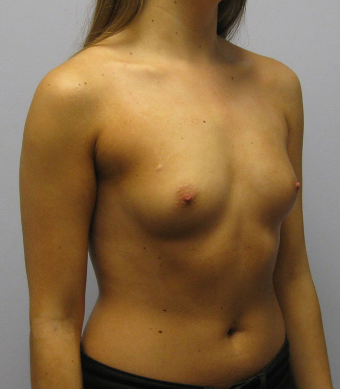 Breast Augmentation Before & After Image