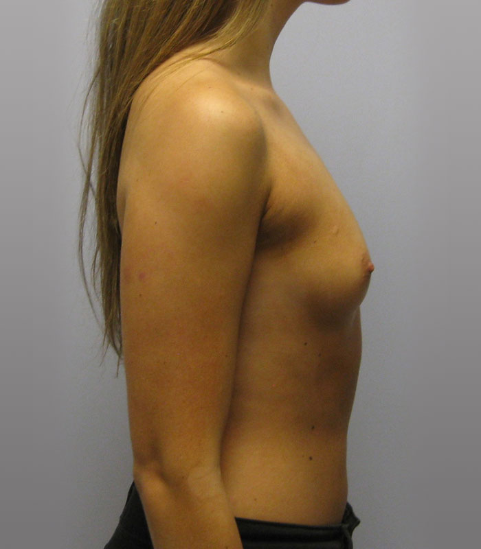 Breast Augmentation Before & After Image