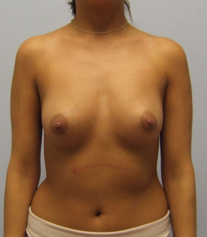 Breast Augmentation Before & After Image