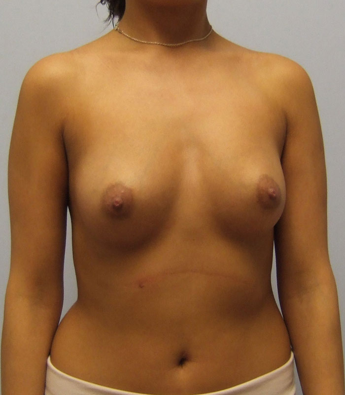 Breast Augmentation Before & After Image