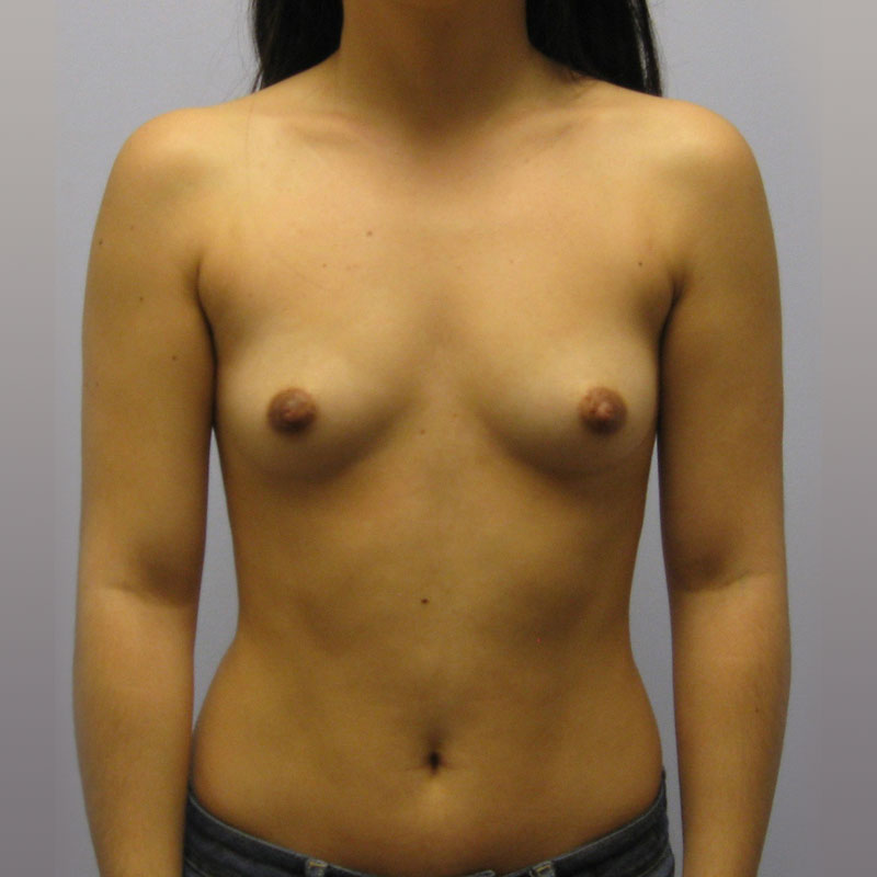 Breast Augmentation Before & After Image