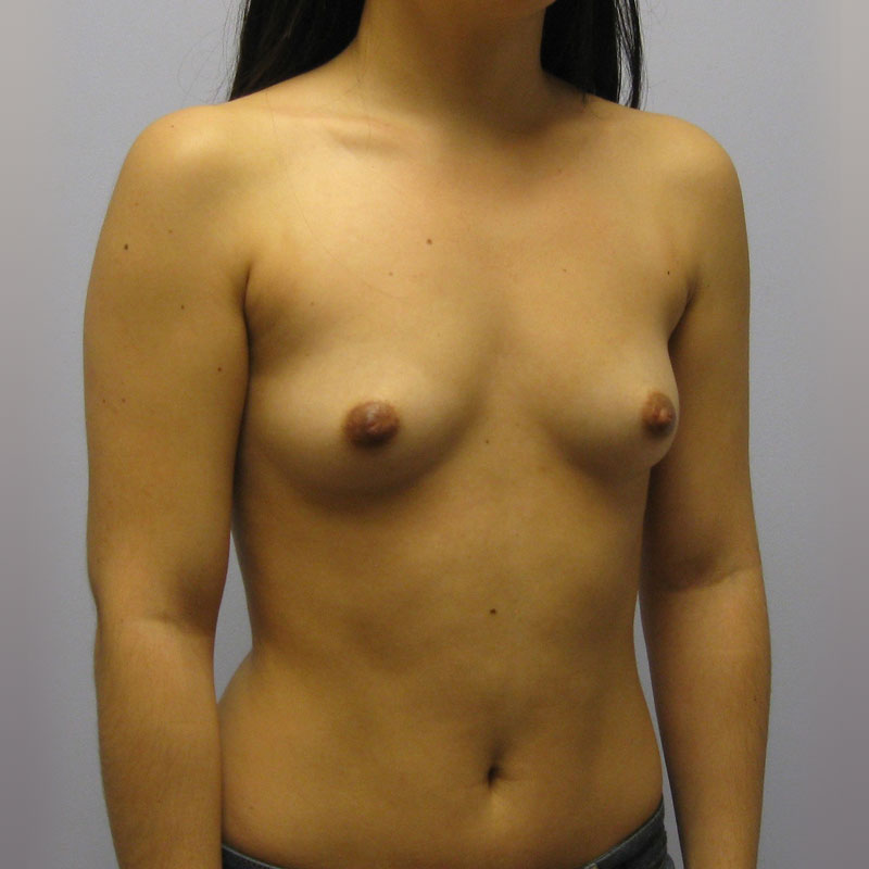 Breast Augmentation Before & After Image