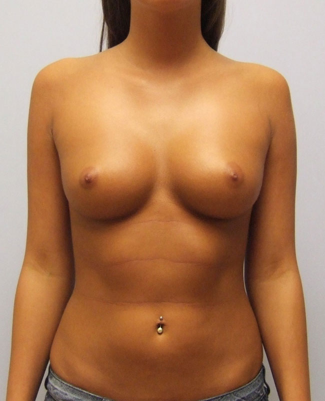 Breast Augmentation Before & After Image