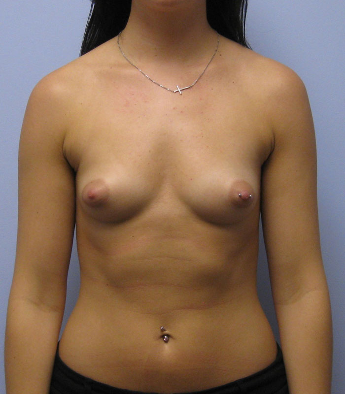 Breast Augmentation Before & After Image