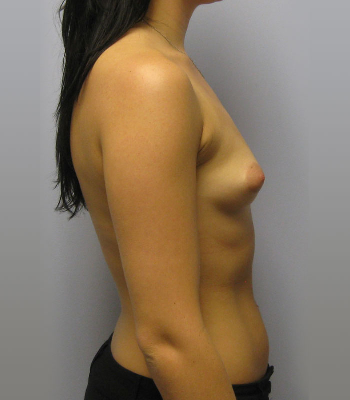 Breast Augmentation Before & After Image