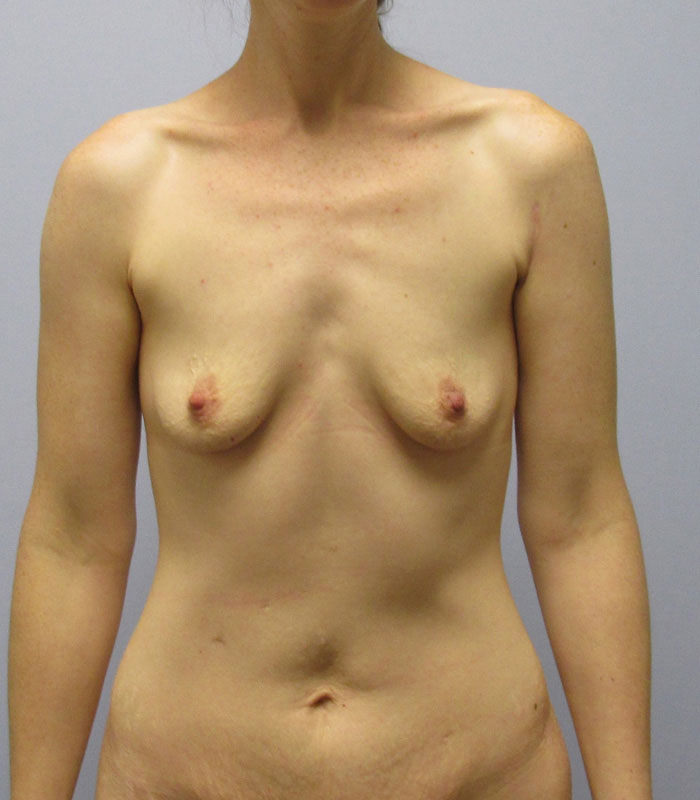 Breast Augmentation Before & After Image