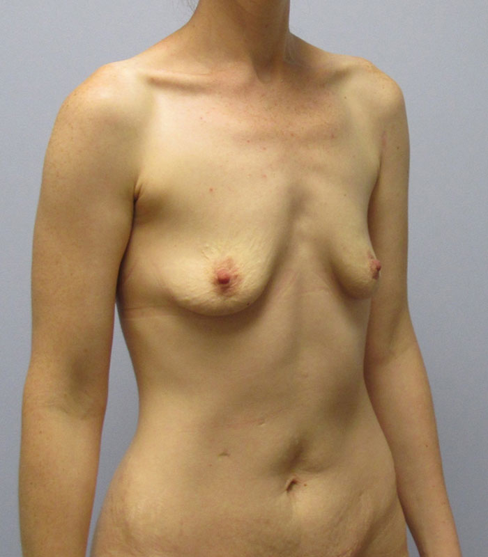 Breast Augmentation Before & After Image